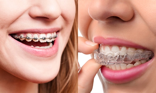 Orthodontics (Braces and Clear Aligners)